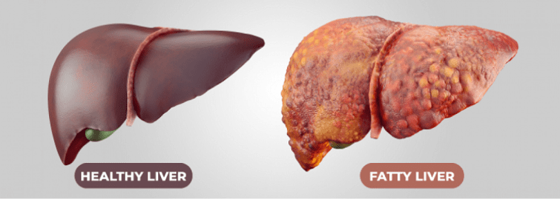 fatty liver