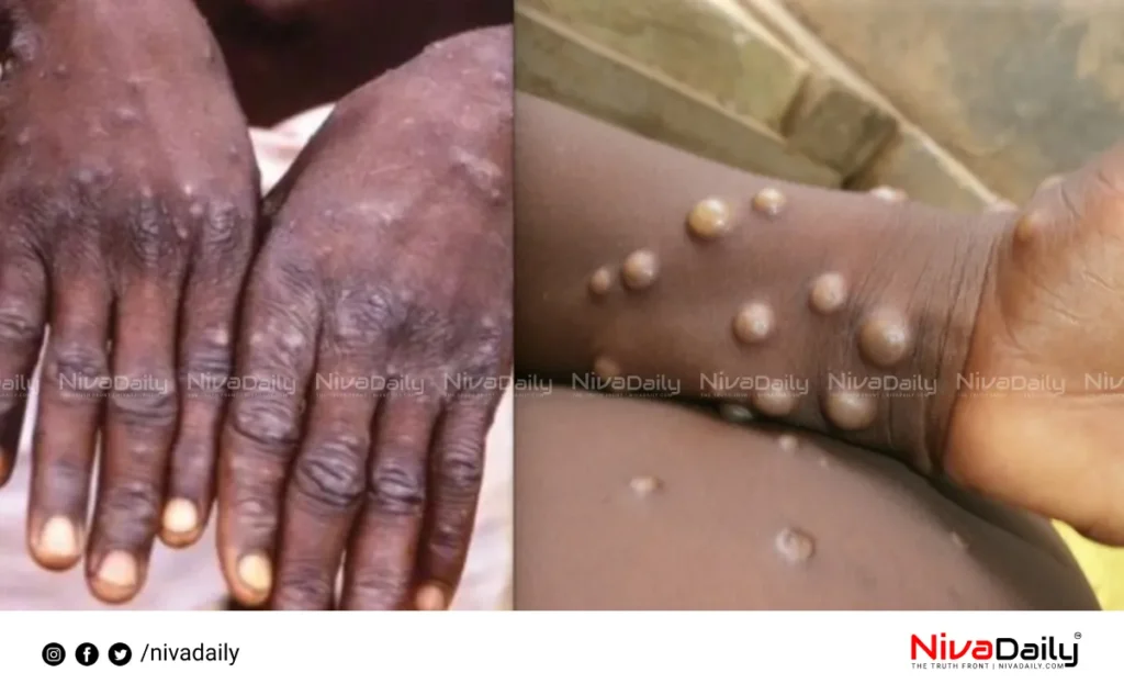 Monkeypox in India