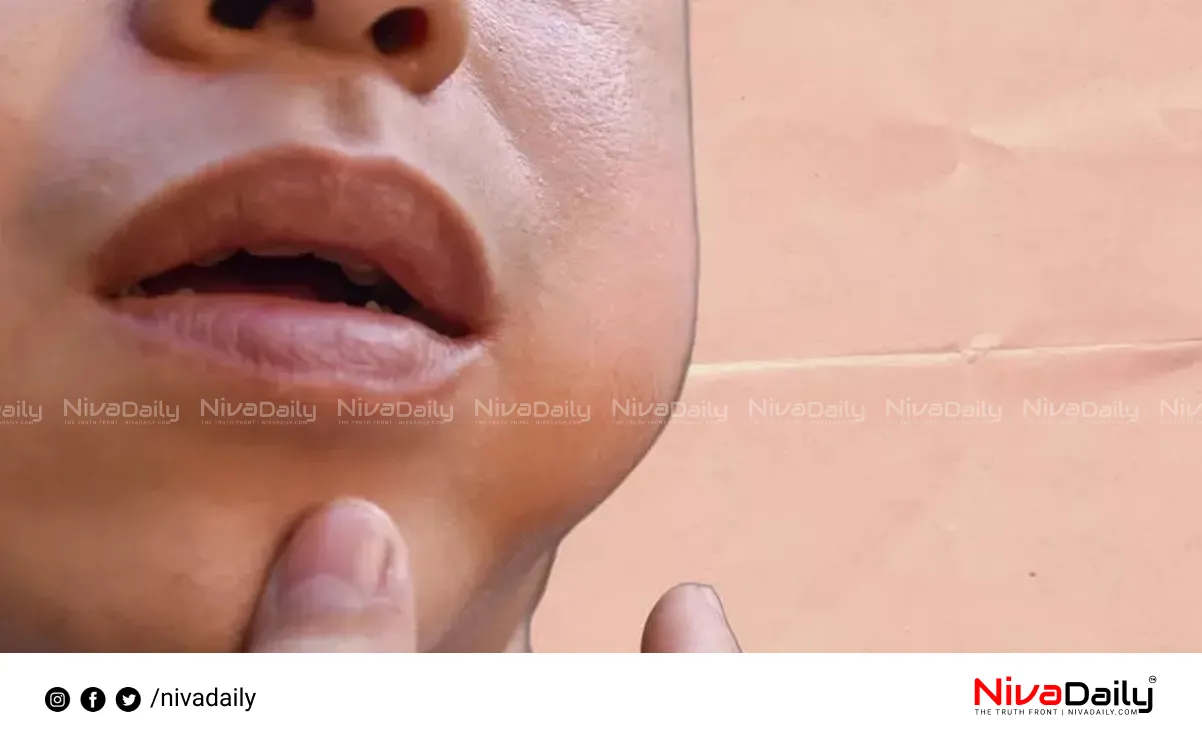 Mumps outbreak Kerala