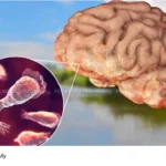 Amoebic Encephalitis