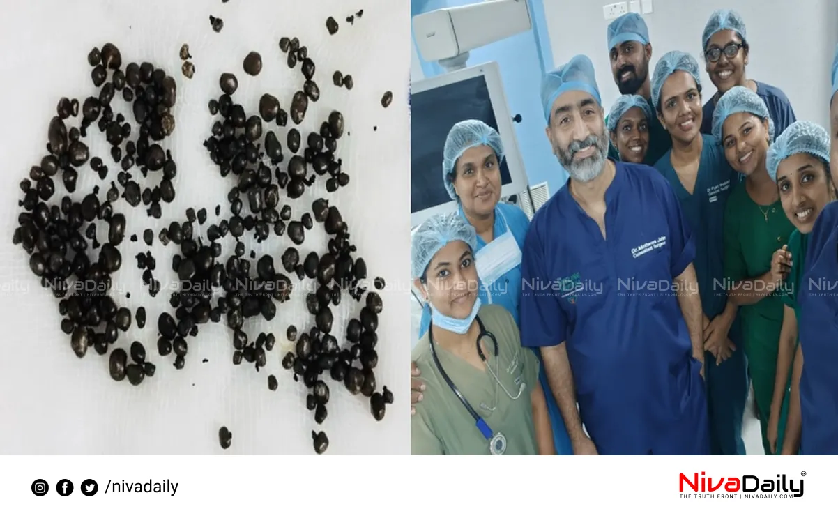 gallbladder stones removal