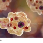 Amebic Encephalitis death