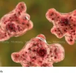 Amebic Encephalitis Outbreak