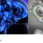 Amoebic Encephalitis death