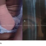 hand amputation case